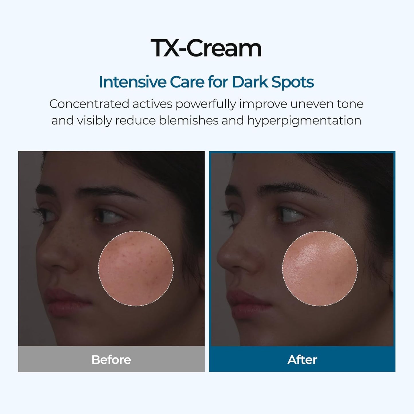 Luhaka®🧪TX Cream Nano-sized Tranexaminc Acid for Dark Spots & Hyperpigmentation